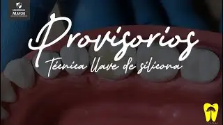 Provisorio de bisacryl técnica llave de silicona | Paso a paso