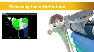 Mako Total Knee Final 20171221