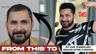My Hair Transplant Experience after 4 Months | Revealing all secrets of my hair growth | Vlog