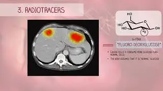 YTDown com YouTube PET vs SPECT scan Dr Paulien Moyaert Media E4YrZ6k9Yd0 001 1080p