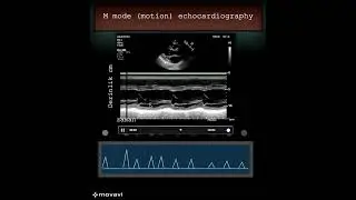M mode (motion) echocardiography