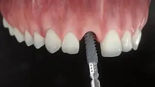 IMPrESS Implant Center Shares Same-Day Permanent Implant in Vancouver & Burnaby BC