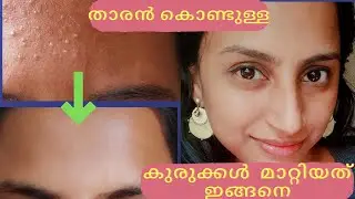 How to remove tinybumps at home/home remedy for pimples malayalam #tinybumps #pimplesolution #acne
