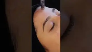 Microagulhamento facial com PDRN