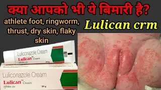 Luliconazole 1% cream | सभी तरह के फंगल इंफेक्शन के लिए बनाई गयी cream