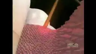 Jackson MS Periodontists Sharing NBC News Video on New Laser Dental Surgery for Gum Disease