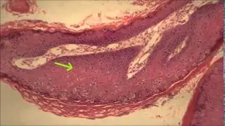 Papiloma