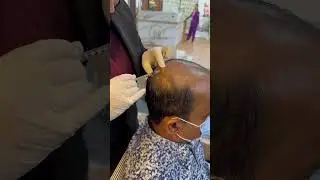 Hair PRP #hairfall #hairfalltreatment #doctor #viral #shortvideo #viralvideo #shorts #short #youtube
