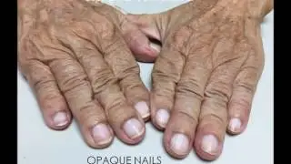 Dr Chi's Fingernail and Tongue Analysis - Opaque Nails