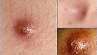 Why Your Skin Breaks Out During Your Period