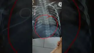 Pigtail catheter 🧑&zwj;⚕️ #chestdrainage #pigtails #pigtail_cathter