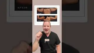 Arm Liposuction - Gentle Sculpt
