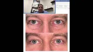 Upper Lower Blepharoplasty with Dr. Burroughs from Springs Aesthetics in Colorado Springs