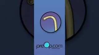 PreOp&reg; Heart Stent (PCI) Patient Education | Cath Lab Flow, Risks, and Aftercare #shorts