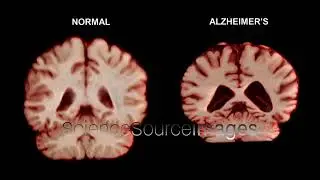 Normal Brain & Brain with Alzheimer's MRI