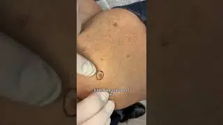 Dermatologist with 50 Years Experience Shows Different Mole Types on Patient #moles #moletypes