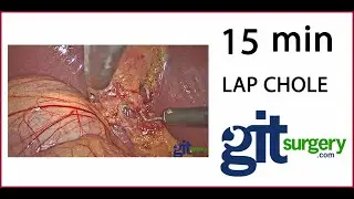 Fifteen minutes Laparoscopic Cholecystectomy UNedited Hook Only Posterior Approach Safety Triangle