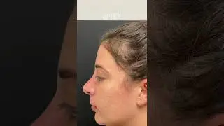 Female Rhinoplasty Transformation | Before & After in Long Island