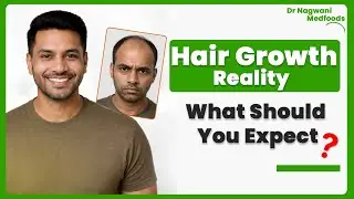 Hair Growth Reality | Realistic Hair Growth Timeline | No Miracle Hair Growth