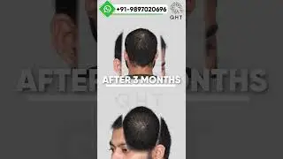 hair transplant result | fue hair transplant result | garde 3 Vertex #besthairtransplantinindia