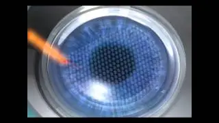 Intralase Animation