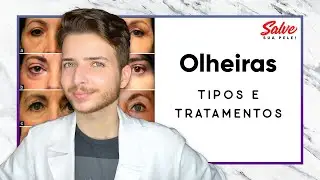 Olheiras Como Acabar