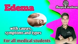 Edema in hindi|swelling, cause and types of edema |medical lecture#nursing #medicaleducation #edema 