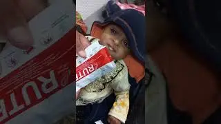 Severe Acute Malnutrition child |[RUTF Appetite test]