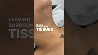 Laser Hair Removal Explained!