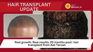 20 Month Hair Transplant Update | Crown & Donor Area Progress