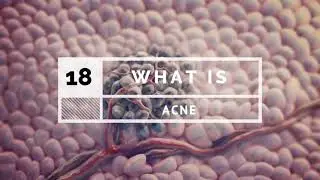 Acni | acni