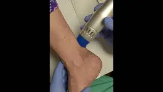 Ultrasound Shockwave Therapy