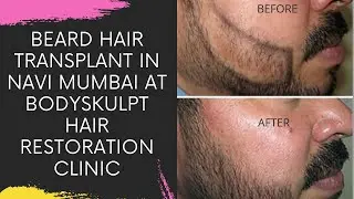 BEARD HAIR TRANSPLANT IN NAVI MUMBAI AT BODYSKULPT HAIR RESTORATION CLINIC