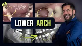 Closing remaining space in Lower Arch #3 | ORTHODONTIC TIPS