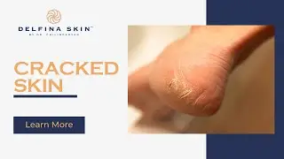 How to Relieve Dry and Cracked Skin with Delfina