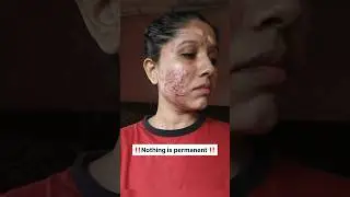 Before & After | Acne Journey #shorts #youtubeshorts #acne