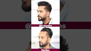 Elvish Yadav Hair Transplant Results: Must See Before & After Transformation! #hairtransplant
