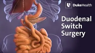 Duodenal Switch Surgery | Duke Health