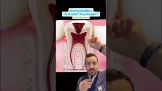 Pourquoi faut-il d&eacute;vitaliser une dent ? C&rsquo;est quoi la d&eacute;vitalisation ?