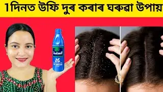 1 দিনতে উফি দুৰ কৰাৰ ঘৰুৱা সহজ উপায়।। Dandruff remove home remedie 