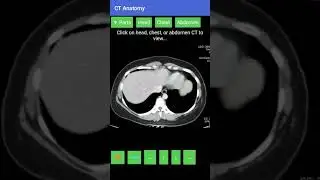 Ct Abdomen filming.....