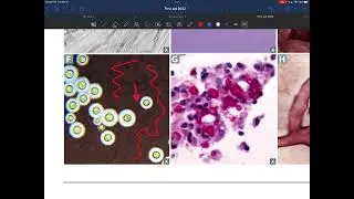 Opportunistic fungal infections USMLE First aid Microbiology page 150-151