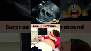 Biggest but Best Surprise 🥰 Twins on First Pregnancy Ultrasound Scan #pregnancy #twin