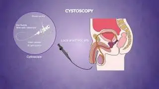 Cystoscopy