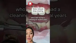 Глубокая чистка и удаление зубного камня #шорты