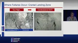 Chronic DVT and Venous Stent Failures: My Best Advice | Dr. Erin Murphy at TED 2024