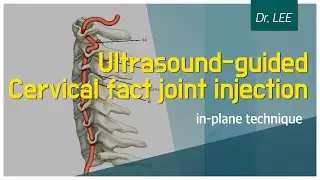 Trailer_Ultrasound-guided cervical facet joint injection; in-plane technique, case and anatomy