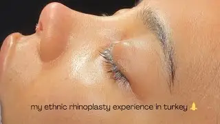 My Ethnic Rhinoplasty Experience in Turkey