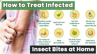 Doctors Don&rsquo;t Want You to Know This: How to Treat Infected Insect Bites at Home