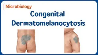 3. Врожденный дерматомеланоцитоз 👶 | Монгольское пятно | USMLE Step 1 🧬✨